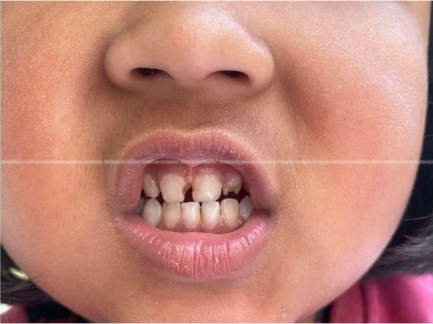 जुरिच किन्डरगार्डेनमा निःशुल्क दन्त शिविर सम्पन्न